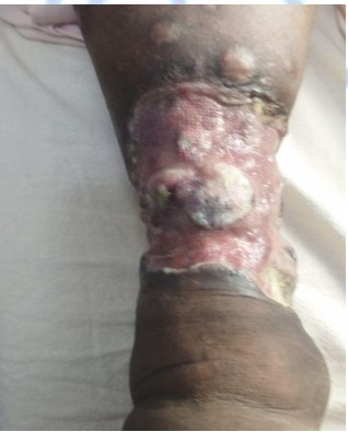 After Treatment