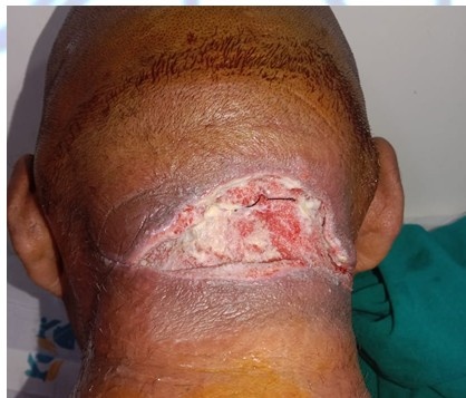 After Treatment