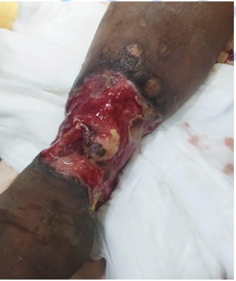 Before Treatment